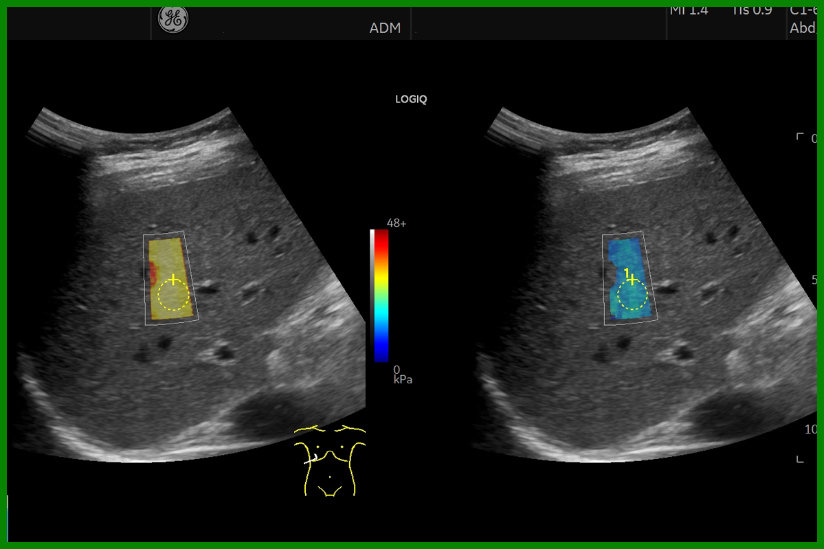 Elastografie hepatică