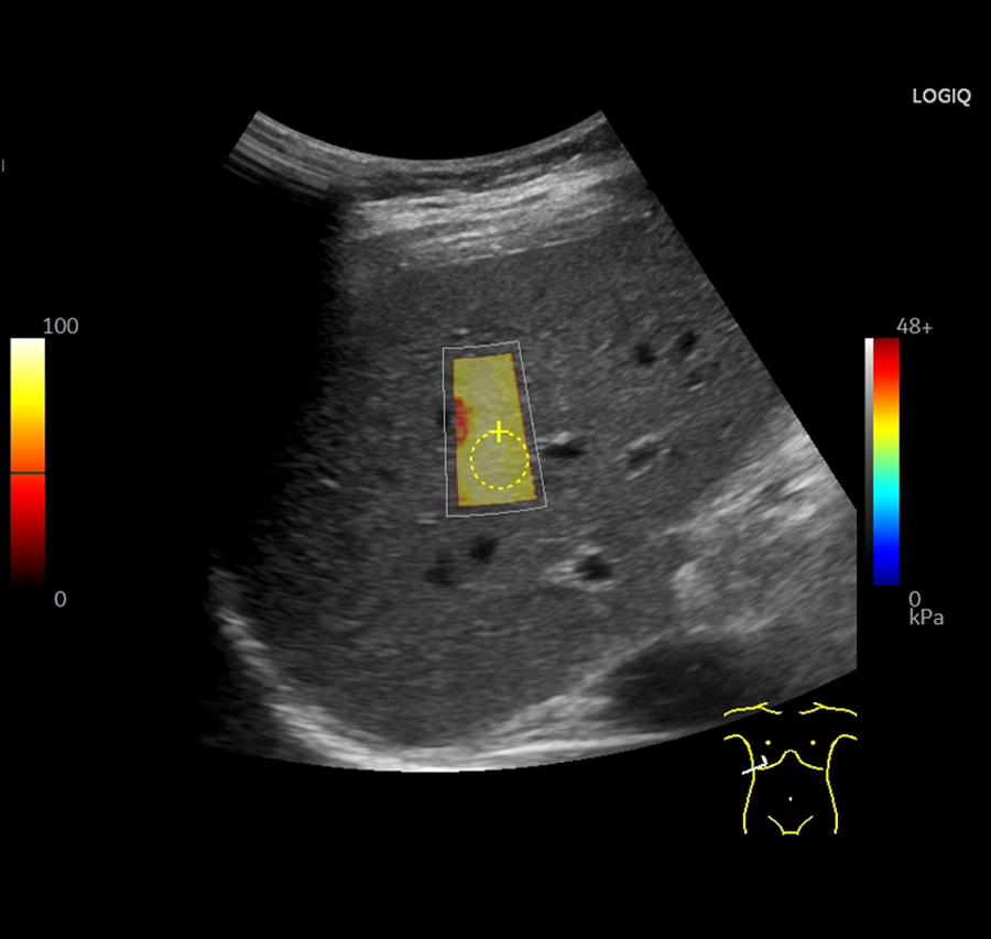 Elastografie hepatică, Viamed Timisoara, gastroenterologietimisoara.ro