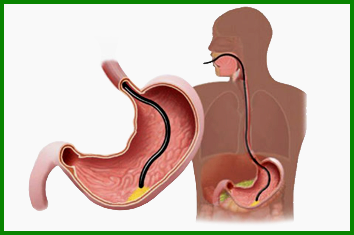 Gastroscopie