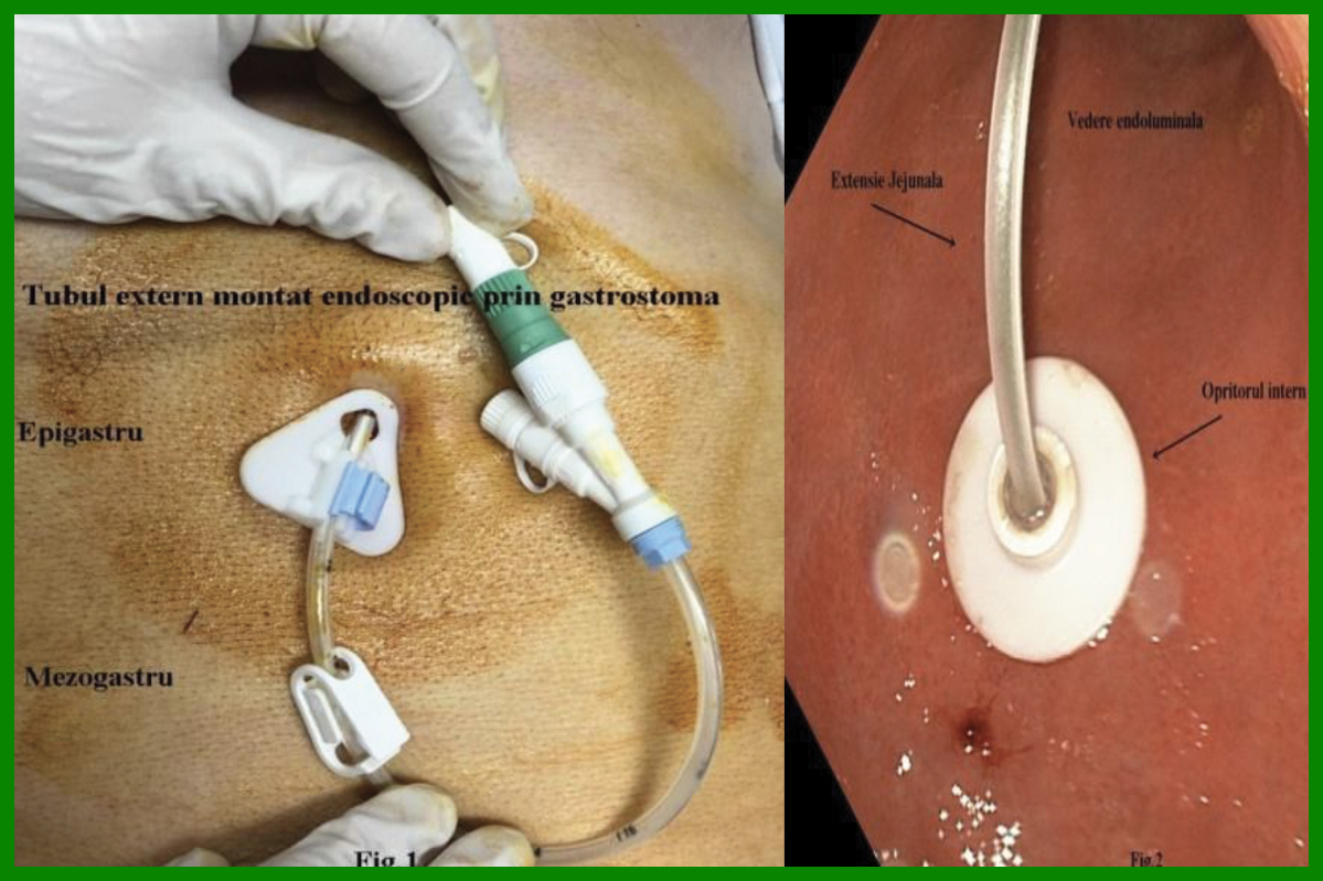 Montare gastrostoma