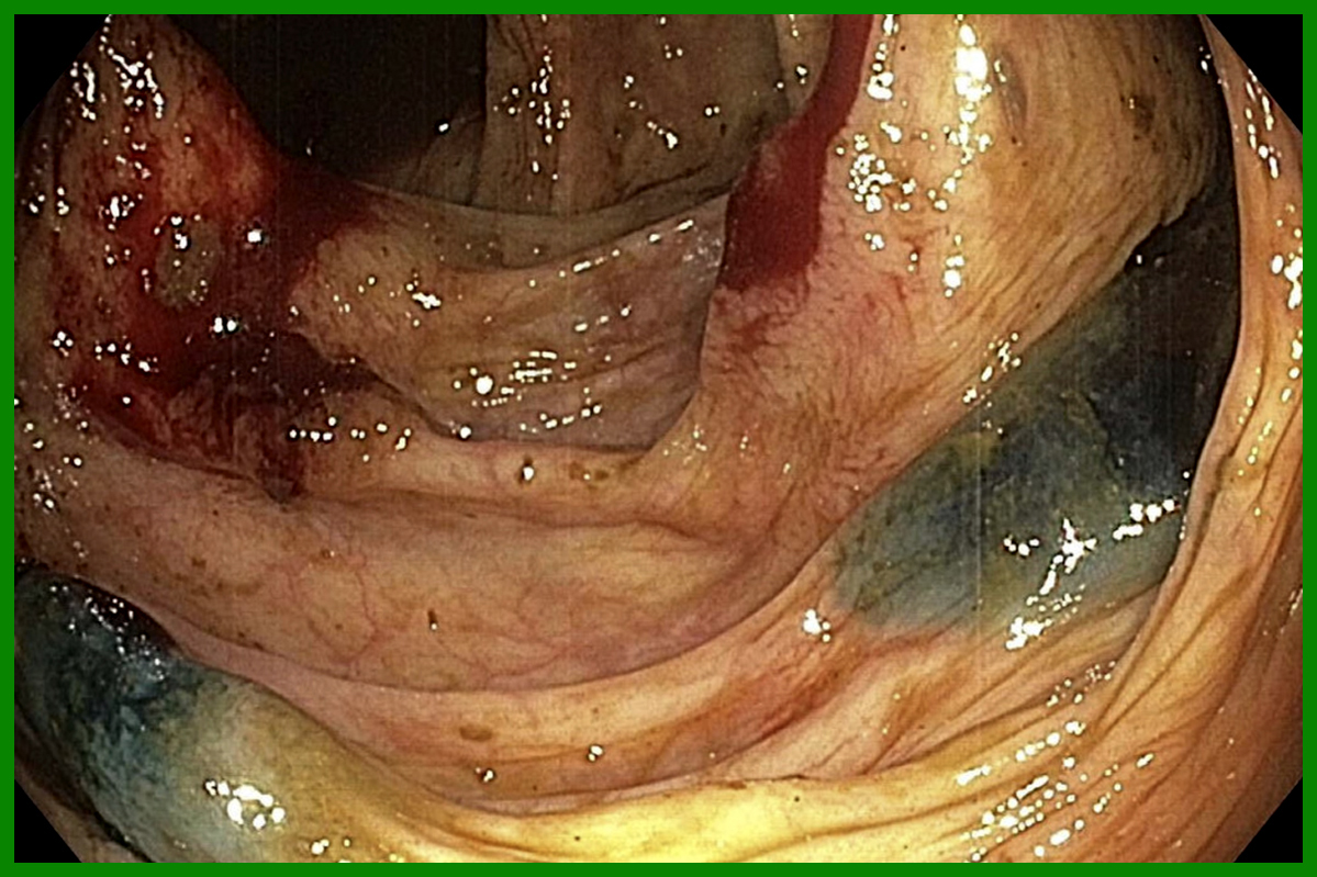 Tatuaj endoscopic